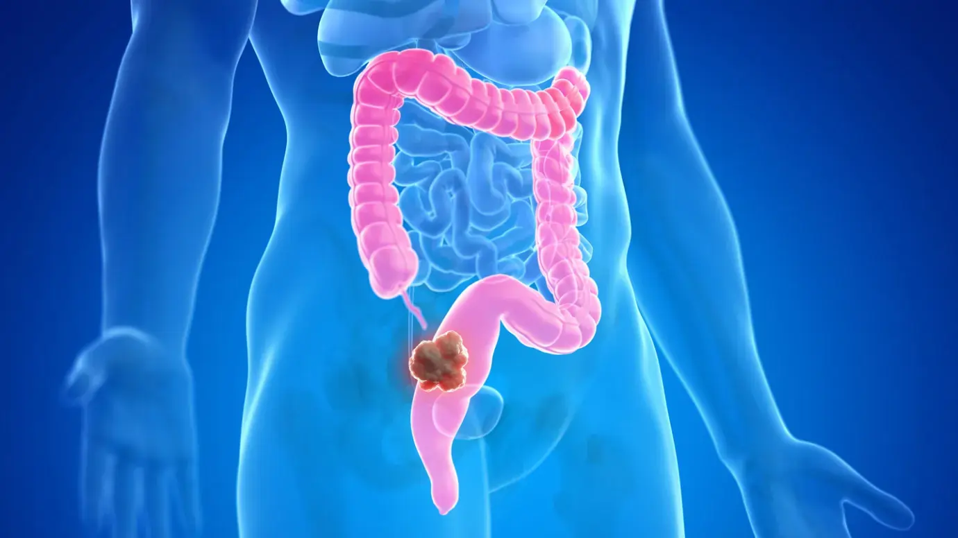 biochemistry of colon cancer