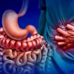 bowel cancer stomach noises​